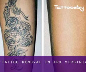 Tattoo Removal in Ark (Virginia)