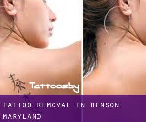 Tattoo Removal in Benson (Maryland)