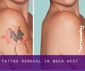 Tattoo Removal in Boca West