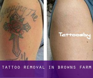 Tattoo Removal in Browns Farm