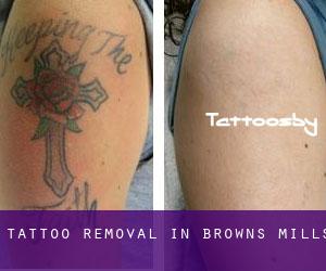 Tattoo Removal in Browns Mills