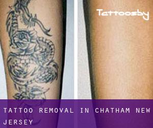 Tattoo Removal in Chatham (New Jersey)