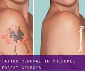Tattoo Removal in Cherokee Forest (Georgia)