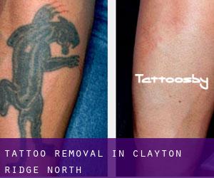 Tattoo Removal in Clayton Ridge North