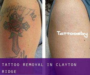 Tattoo Removal in Clayton Ridge