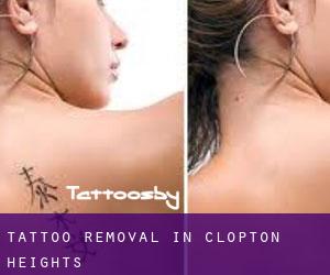 Tattoo Removal in Clopton Heights