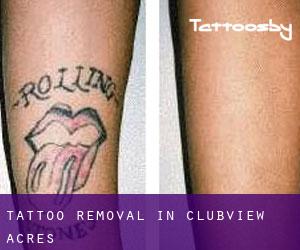 Tattoo Removal in Clubview Acres
