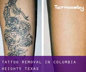 Tattoo Removal in Columbia Heights (Texas)