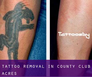 Tattoo Removal in County Club Acres