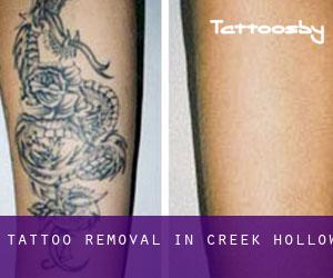 Tattoo Removal in Creek Hollow