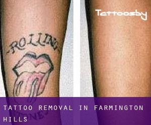 Tattoo Removal in Farmington Hills