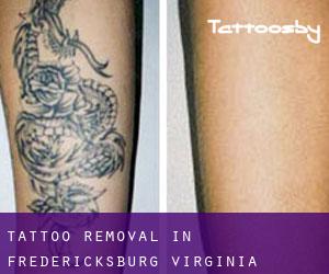Tattoo Removal in Fredericksburg (Virginia)