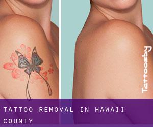 Tattoo Removal in Hawaii County