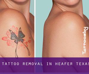 Tattoo Removal in Heafer (Texas)