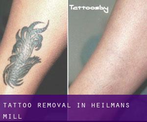 Tattoo Removal in Heilmans Mill