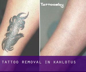 Tattoo Removal in Kahlotus