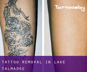 Tattoo Removal in Lake Talmadge