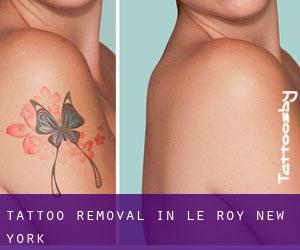 Tattoo Removal in Le Roy (New York)