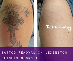 Tattoo Removal in Lexington Heights (Georgia)