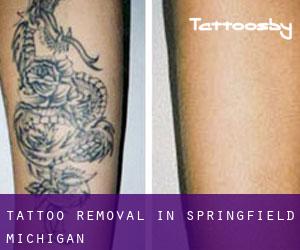 Tattoo Removal in Springfield (Michigan)
