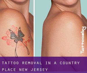 Tattoo Removal in A Country Place (New Jersey)