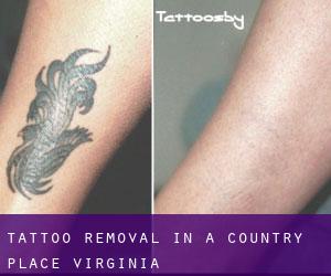 Tattoo Removal in A Country Place (Virginia)