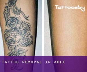 Tattoo Removal in Able