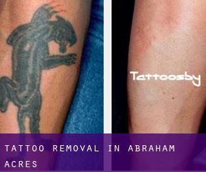 Tattoo Removal in Abraham Acres