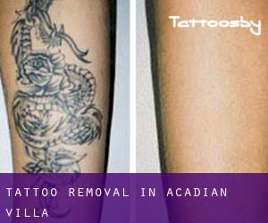 Tattoo Removal in Acadian Villa