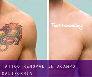 Tattoo Removal in Acampo (California)