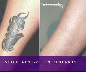 Tattoo Removal in Ackerson