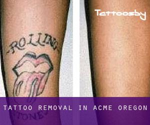 Tattoo Removal in Acme (Oregon)