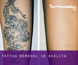 Tattoo Removal in Acolita