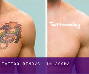 Tattoo Removal in Acoma