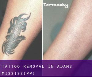 Tattoo Removal in Adams (Mississippi)