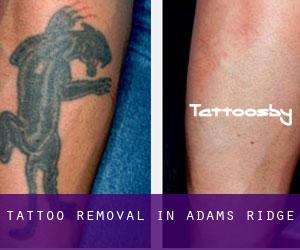 Tattoo Removal in Adams Ridge