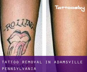 Tattoo Removal in Adamsville (Pennsylvania)
