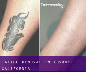 Tattoo Removal in Advance (California)