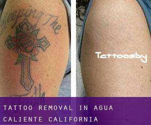 Tattoo Removal in Agua Caliente (California)