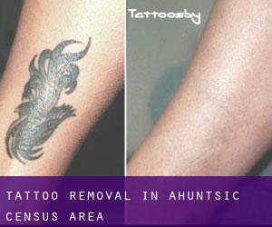 Tattoo Removal in Ahuntsic (census area)