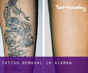Tattoo Removal in Aikman