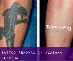 Tattoo Removal in Alabama (Florida)