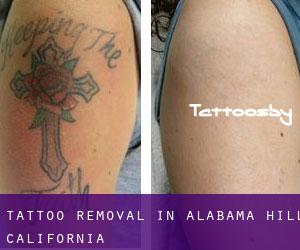 Tattoo Removal in Alabama Hill (California)