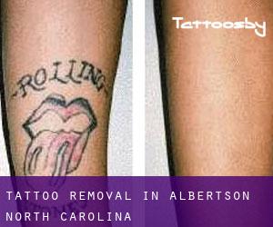 Tattoo Removal in Albertson (North Carolina)