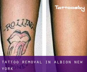Tattoo Removal in Albion (New York)