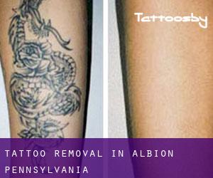 Tattoo Removal in Albion (Pennsylvania)