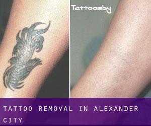 Tattoo Removal in Alexander City