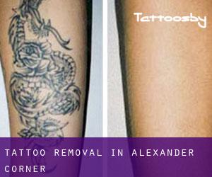 Tattoo Removal in Alexander Corner