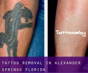 Tattoo Removal in Alexander Springs (Florida)