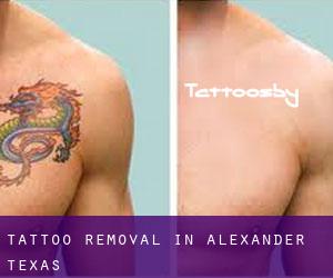 Tattoo Removal in Alexander (Texas)